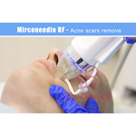 آلة الوخز الدقيقة الجزئية إبرة الراديو الترددي