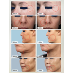 RF Micro-needle + Thermagia Fractional RF System Microneedling RF Fractional Radio Frequency Beauty Equipment