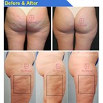 جهاز تدليك إندوسفيرز بكرات لعلاج السيلوليت